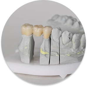 Fixed dental bridge model