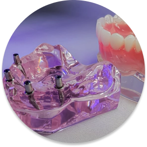 Implant-supported dentures model