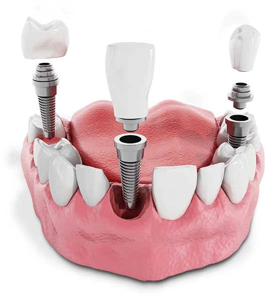 Multiple tooth dental implant model