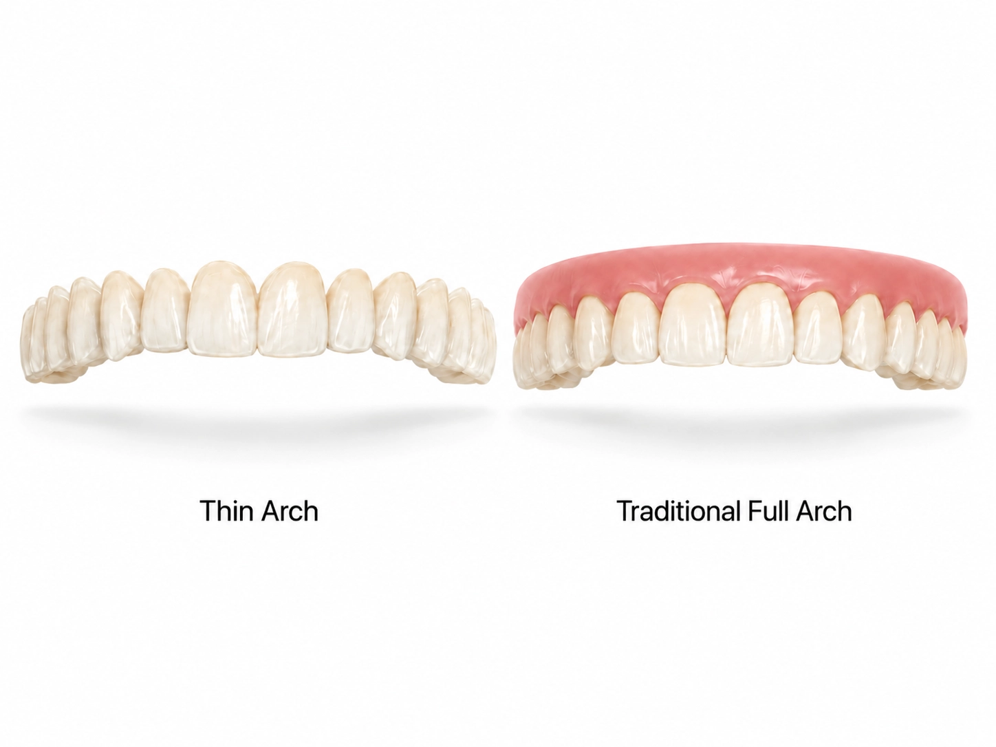 Thin arch vs traditional full arch dental implant prosthesis comparison