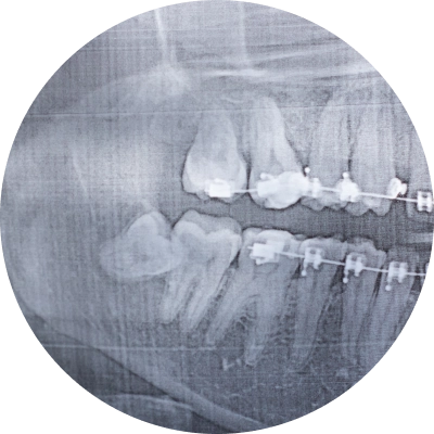 Damaged tooth graphic showing wisdom tooth issues