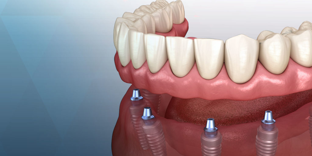 implant supported dentures graphic