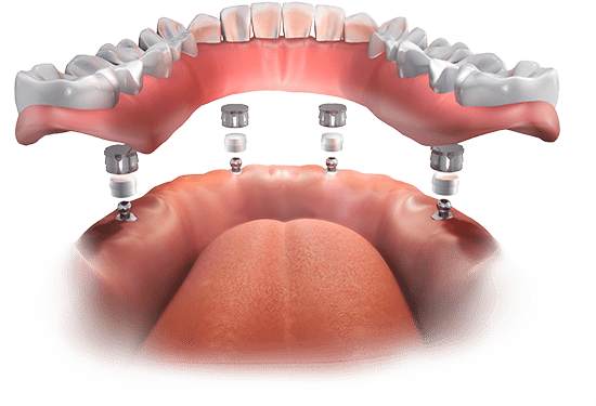 implant supported dentures graphic