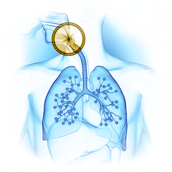 sleep apnea graphic