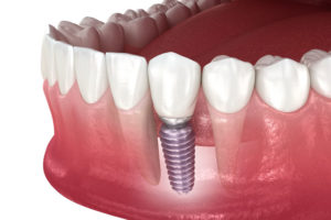 a single dental implant and post being placed into a lower jaw