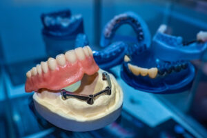 a full mouth dental implant lower arch prosthesis model.