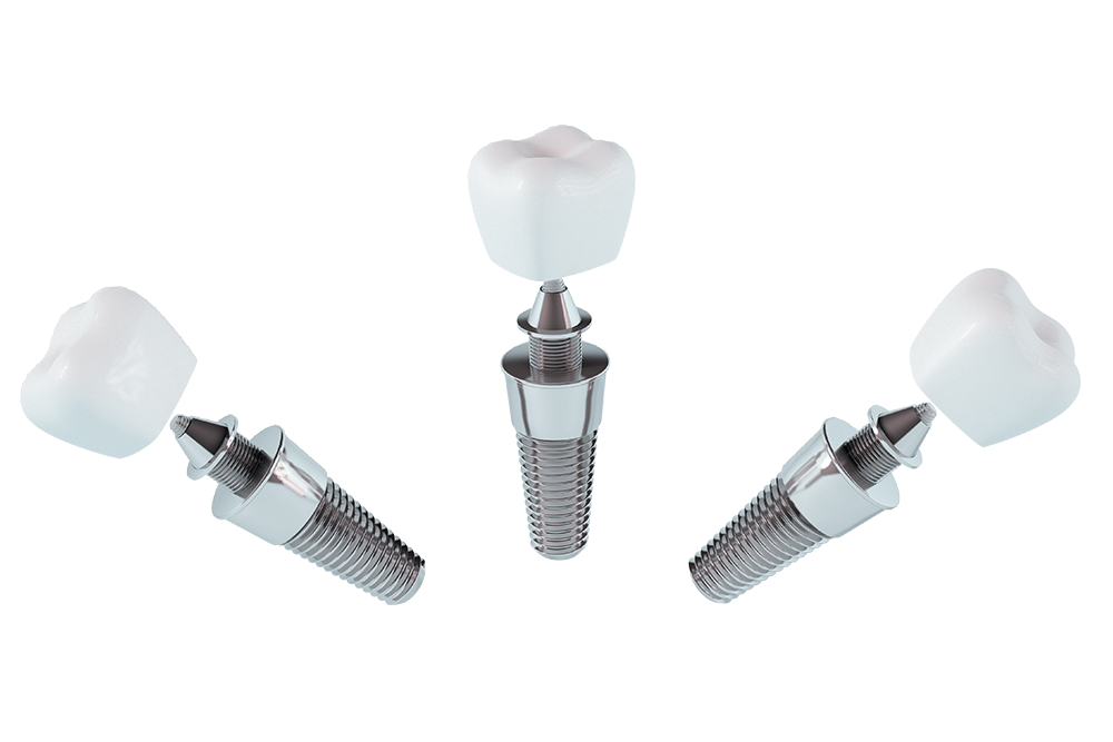 three single dental implant models arranged.