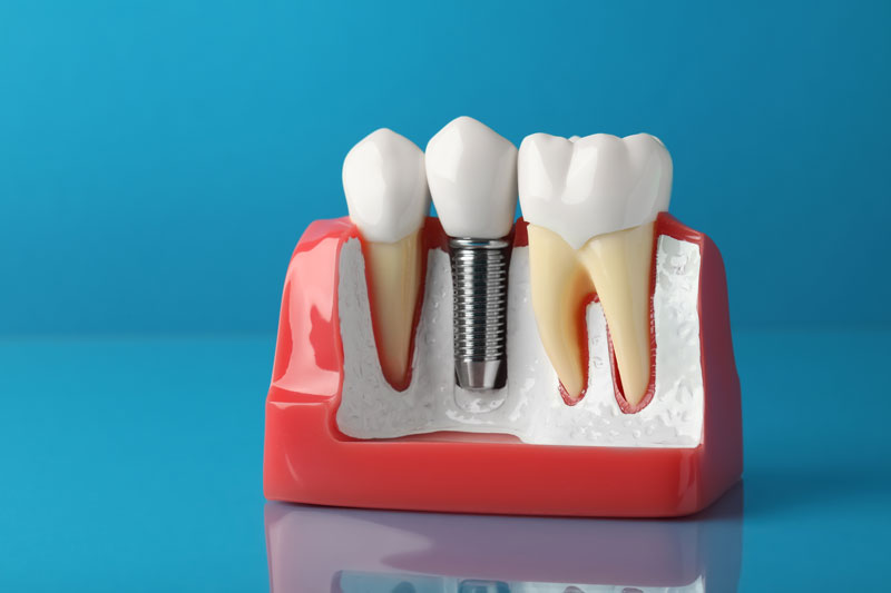 blue background; a dental implant model on reflective glass